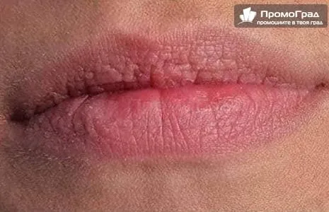Уголемяване на устни безиглено и безболезно с хиалуронова киселина и филър - 6 процедури